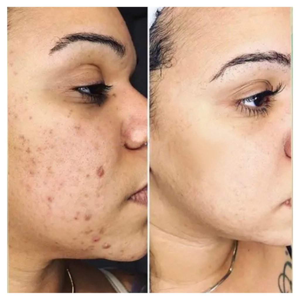 Intense Discoloration Treatment — Rapid Action Dark Spot Cream (Hydroquinone-Free)