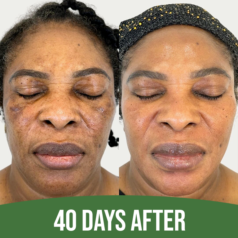 Intense Discoloration Treatment — Rapid Action Dark Spot Cream (Hydroquinone-Free)