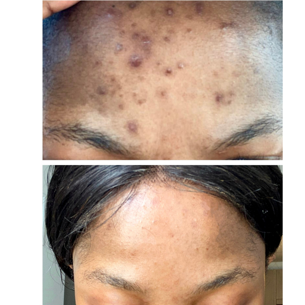 Intense Discoloration Treatment — Rapid Action Dark Spot Cream (Hydroquinone-Free)