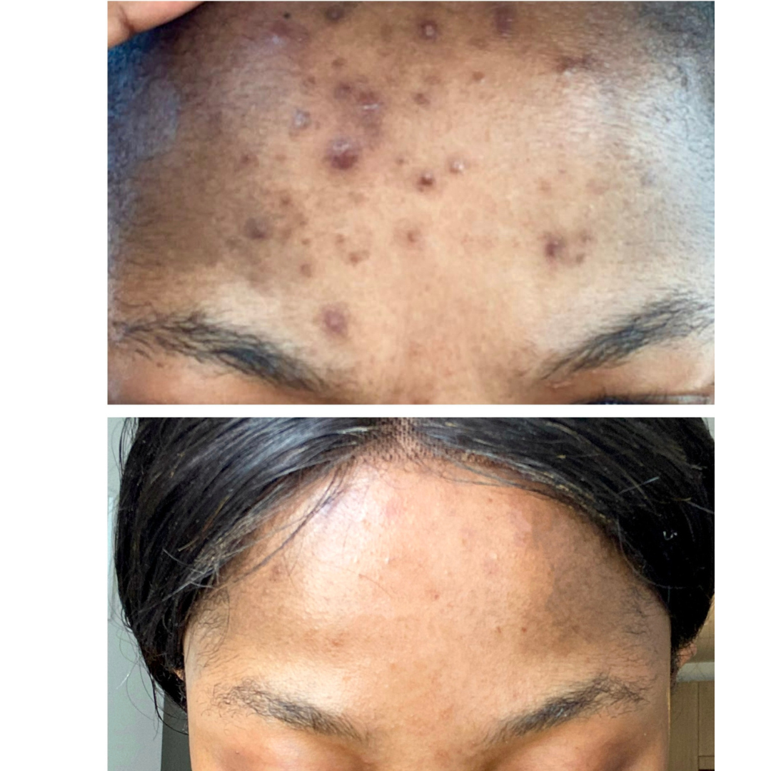 Intense Discoloration Treatment — Rapid Action Dark Spot Cream (Hydroquinone-Free)