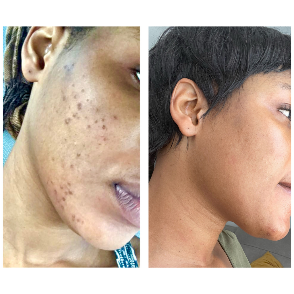 Intense Discoloration Treatment — Rapid Action Dark Spot Cream (Hydroquinone-Free)