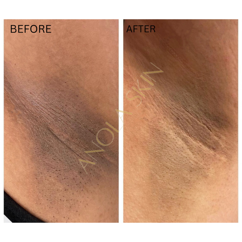 Intense Discoloration Treatment — Rapid Action Dark Spot Cream (Hydroquinone-Free)