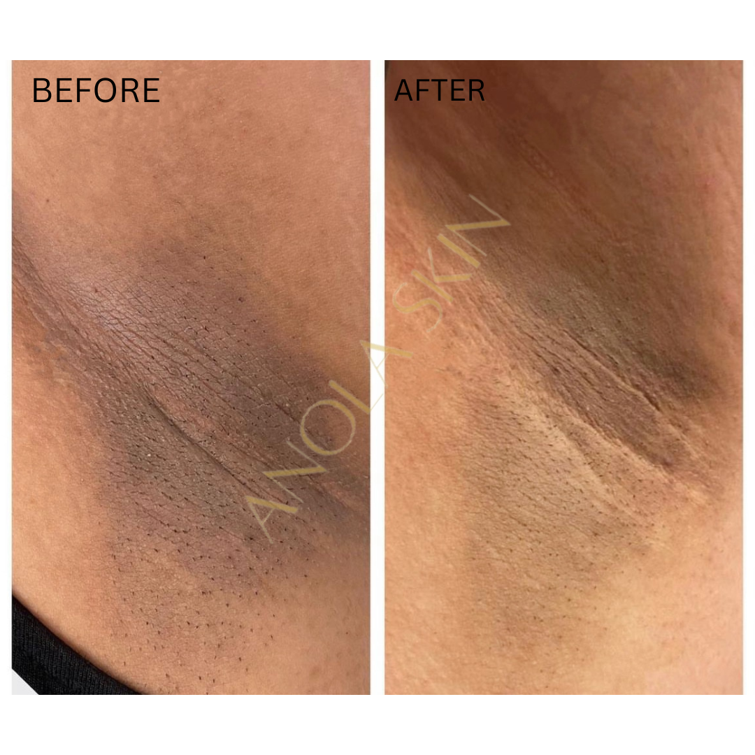 Intense Discoloration Treatment — Rapid Action Dark Spot Cream (Hydroquinone-Free)