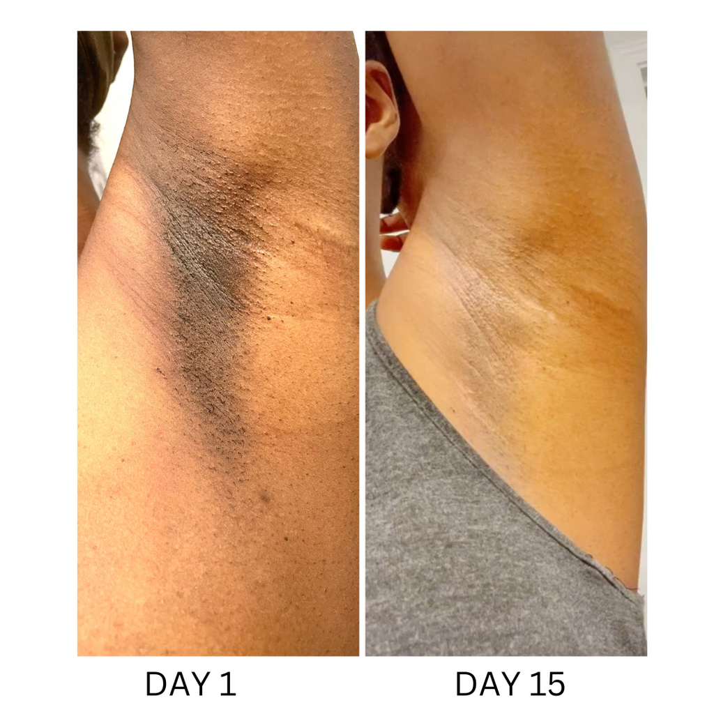 Intense Discoloration Treatment — Rapid Action Dark Spot Cream (Hydroquinone-Free)