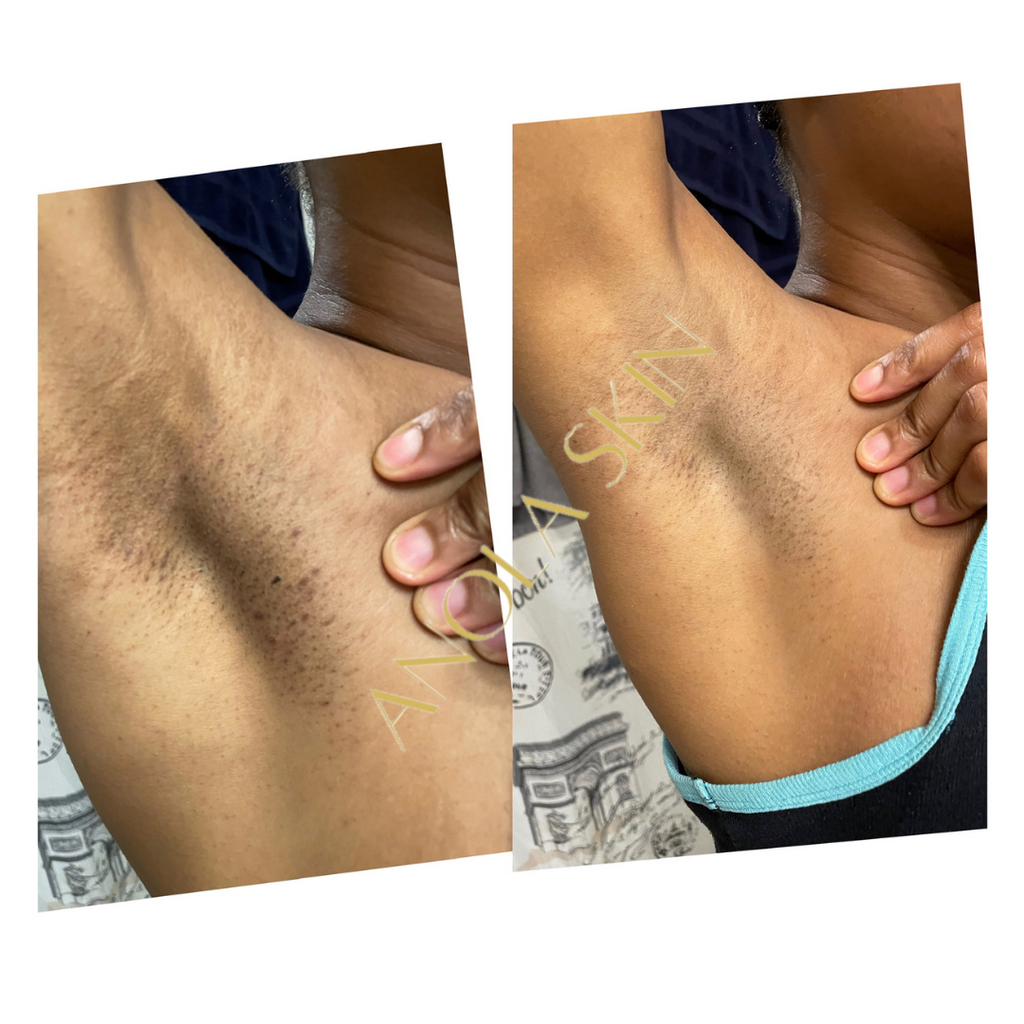 Intense Discoloration Treatment — Rapid Action Dark Spot Cream (Hydroquinone-Free)