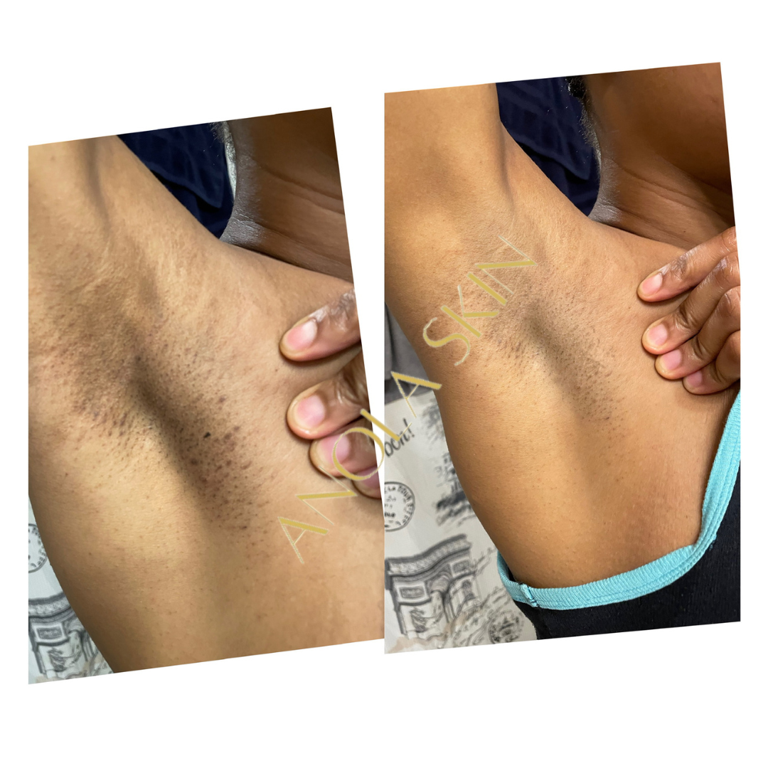 Intense Discoloration Treatment — Rapid Action Dark Spot Cream (Hydroquinone-Free)