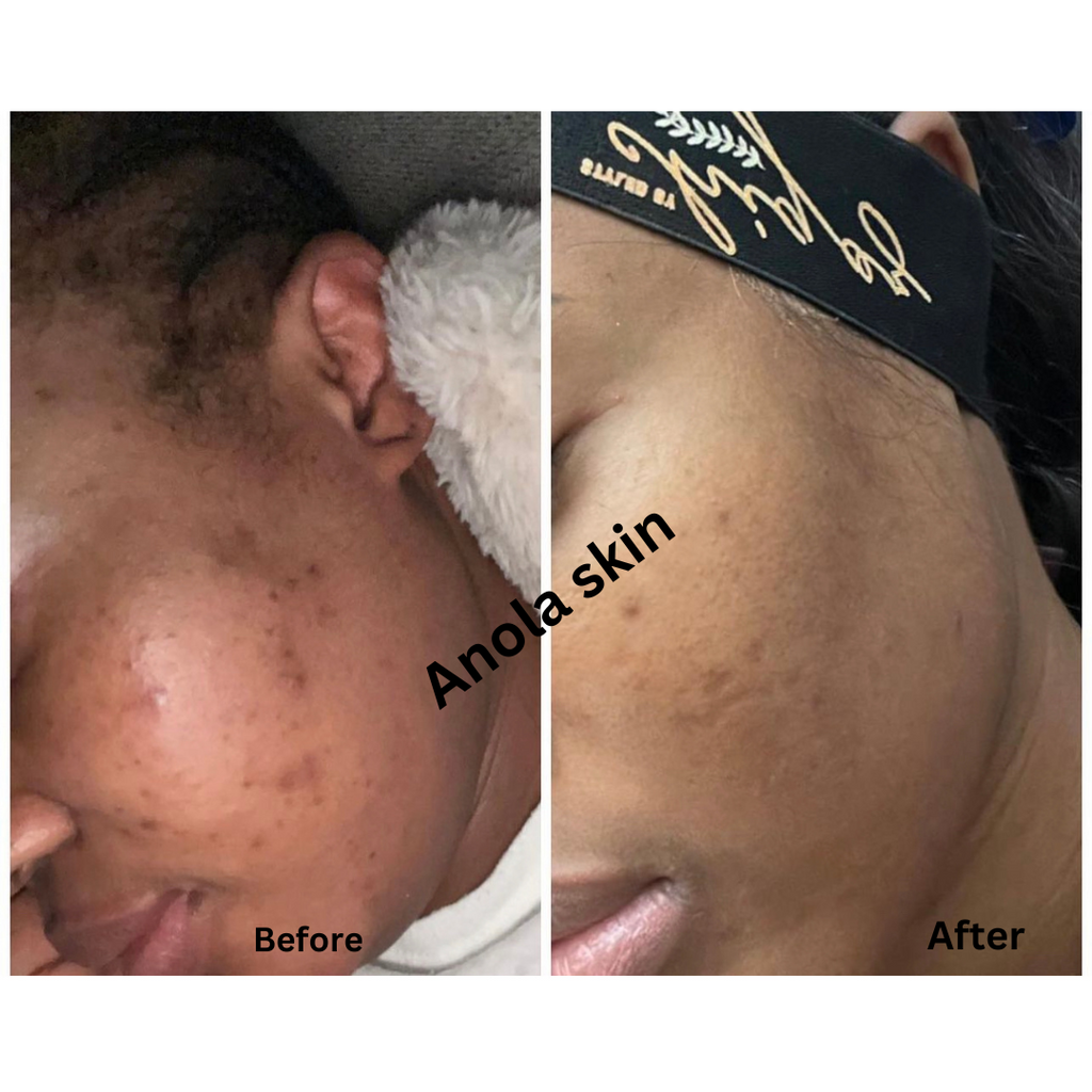 Intense Discoloration Treatment — Rapid Action Dark Spot Cream (Hydroquinone-Free)