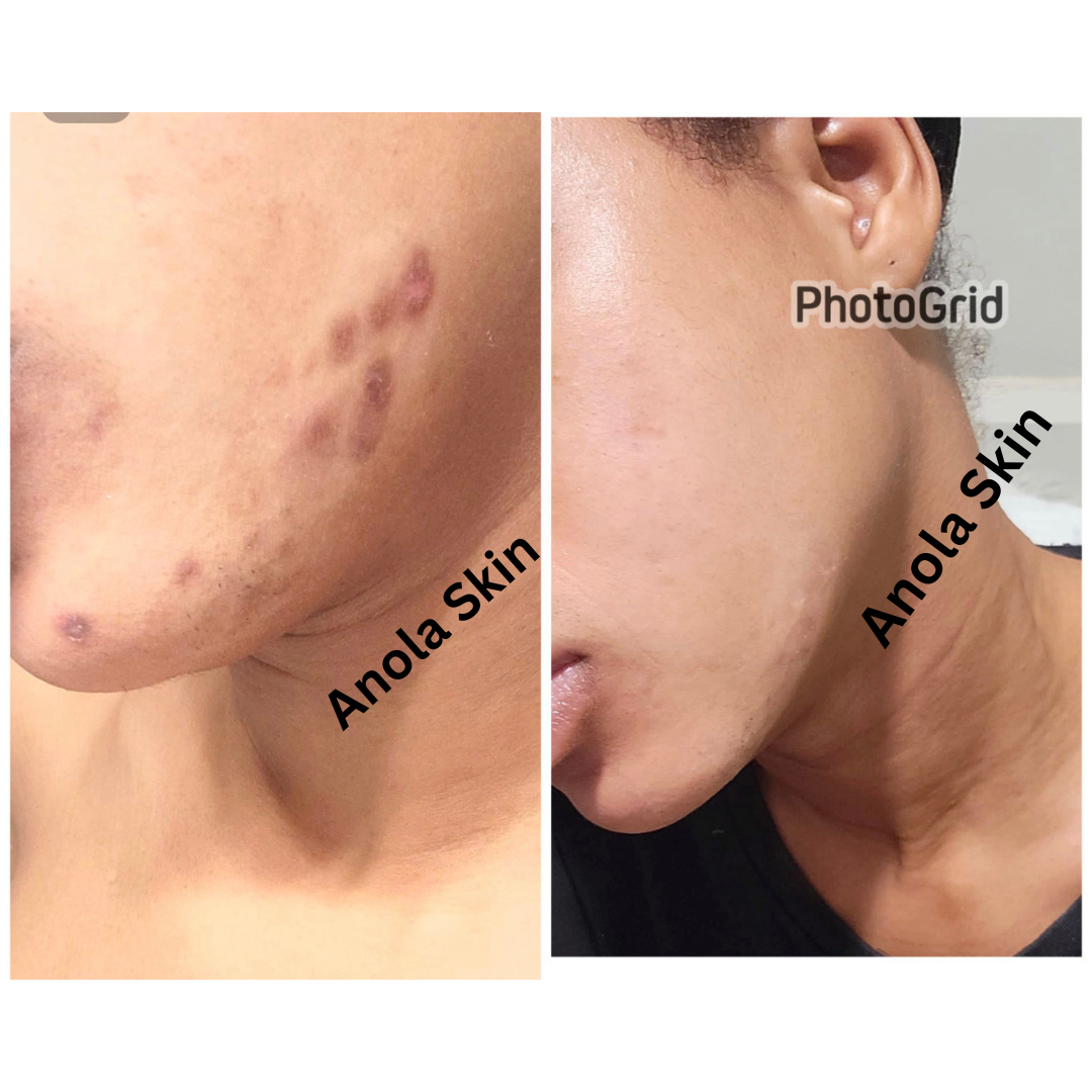 Intense Discoloration Treatment — Rapid Action Dark Spot Cream (Hydroquinone-Free)