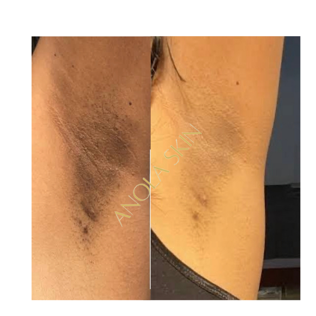 Intense Discoloration Treatment — Rapid Action Dark Spot Cream (Hydroquinone-Free)